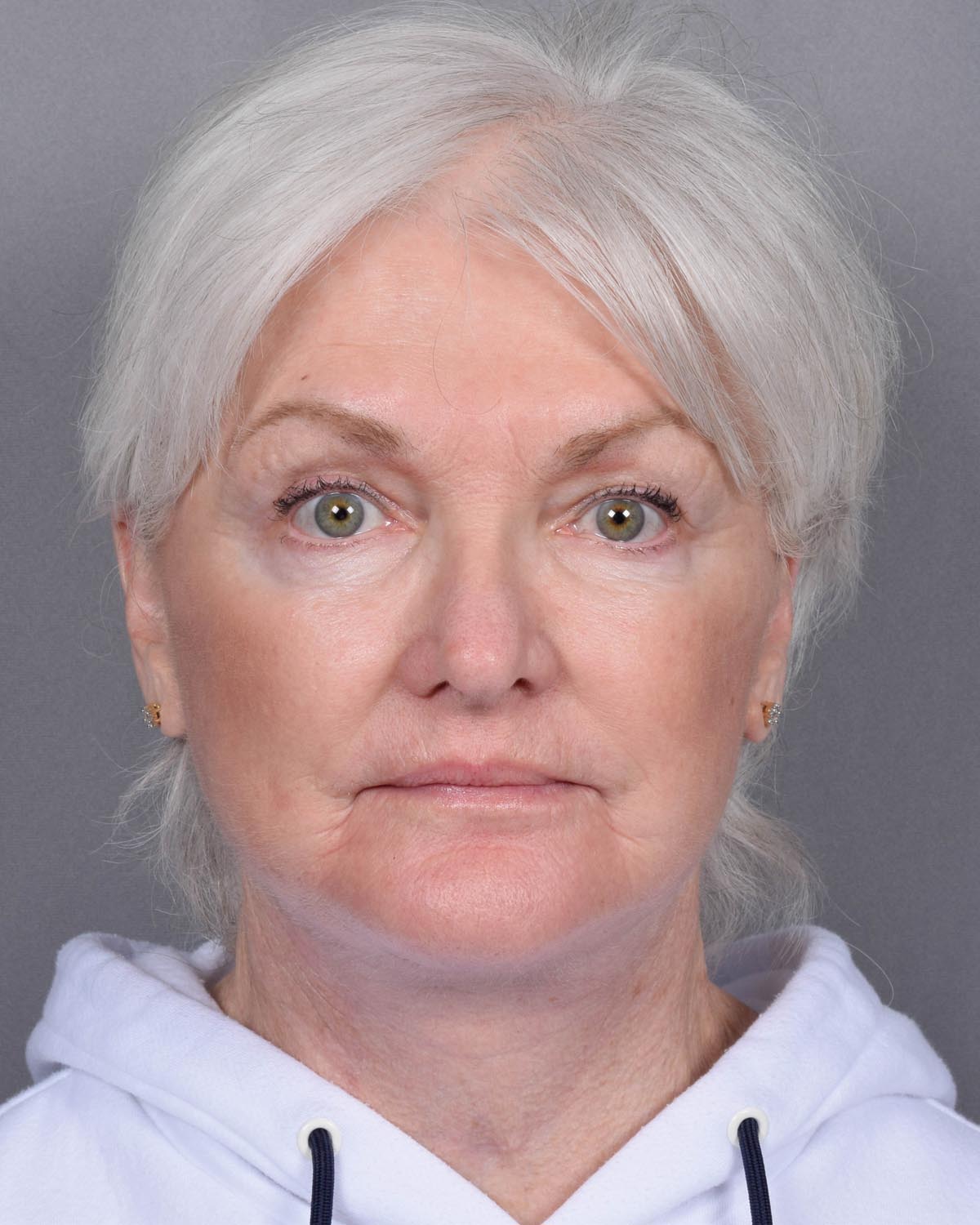 After facelift and neck lift - Vegas Facial Plastics, Mehdi Sina, MD