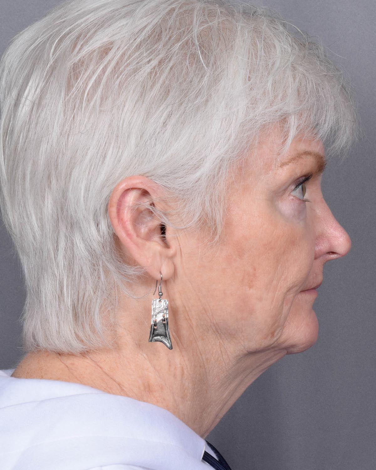 Before facelift and neck lift Profile - Vegas Facial Plastics, Mehdi Sina, MD