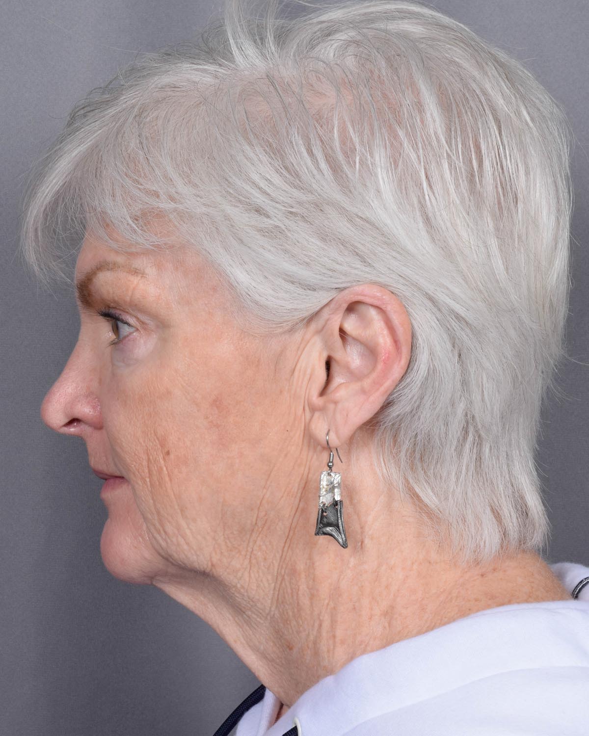 Before facelift and neck lift Profile - Vegas Facial Plastics, Mehdi Sina, MD