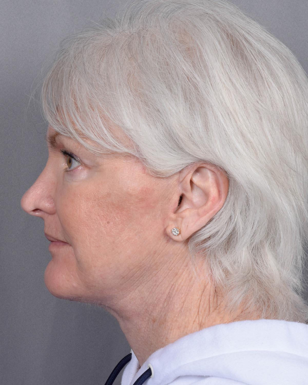 After facelift and neck lift Profile - Vegas Facial Plastics, Mehdi Sina, MD