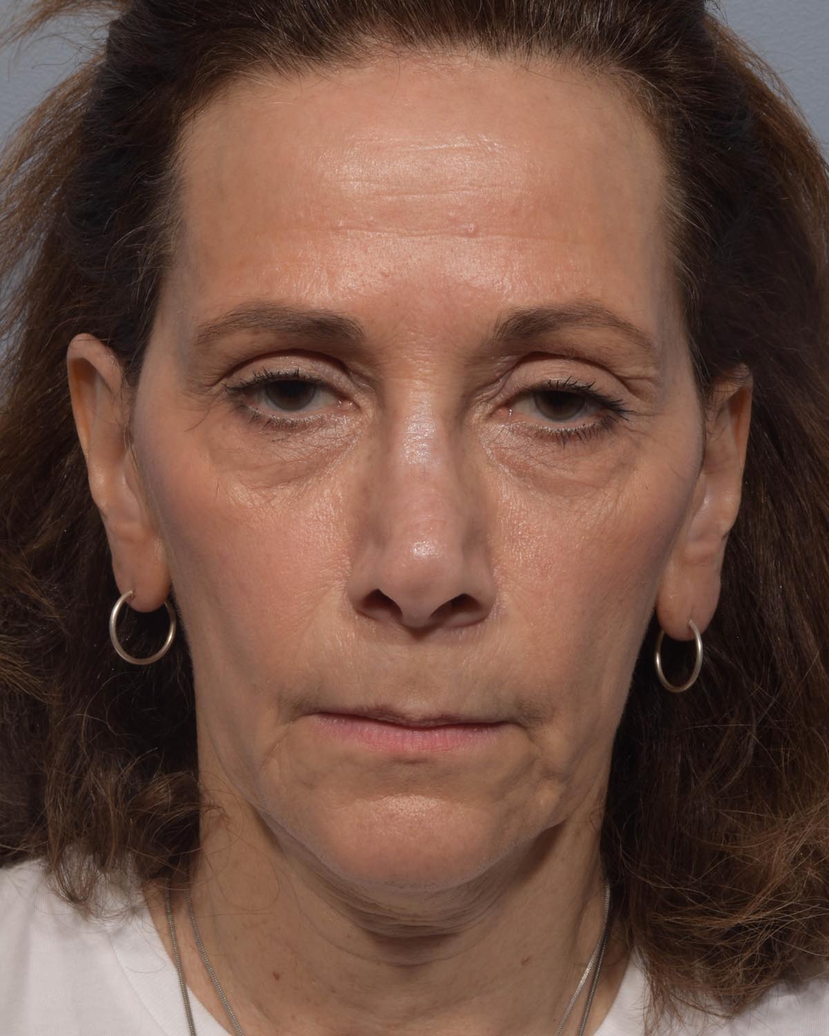 Before Lower Blepharoplasty, facelift and neck lift, full face Laser resurfacing with CO2