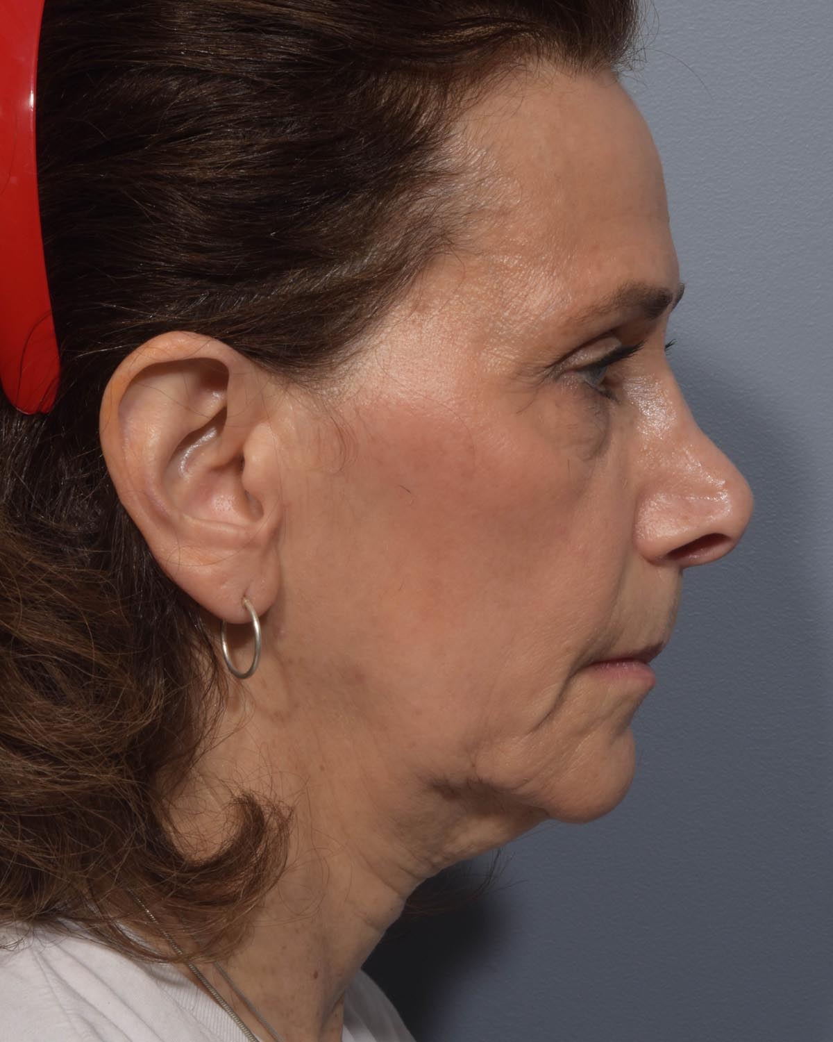Before Lower Blepharoplasty, facelift and neck lift, full face Laser resurfacing with CO2 Profile