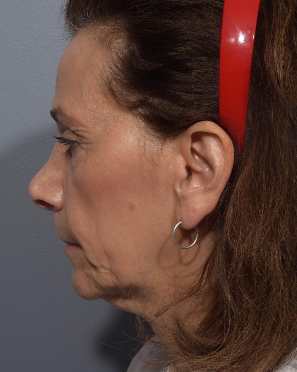 Before Lower Blepharoplasty, facelift and neck lift, full face Laser resurfacing with CO2 Profile