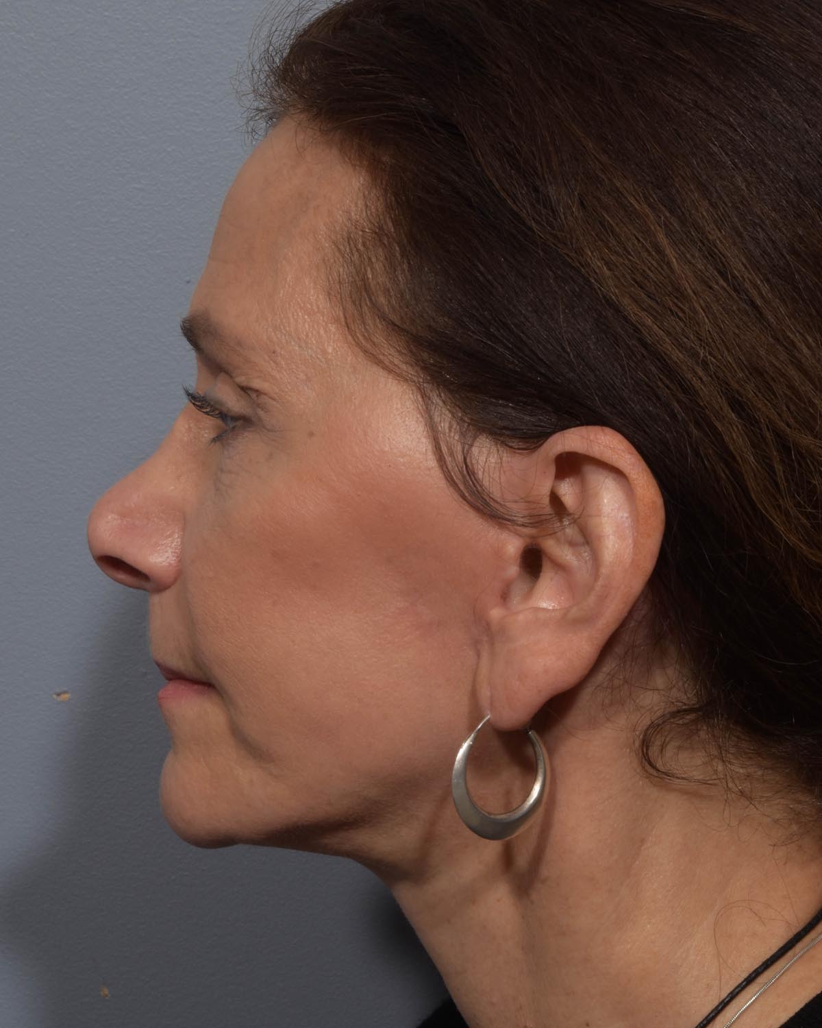 After Lower Blepharoplasty, facelift and neck lift, full face Laser resurfacing with CO2 Profile