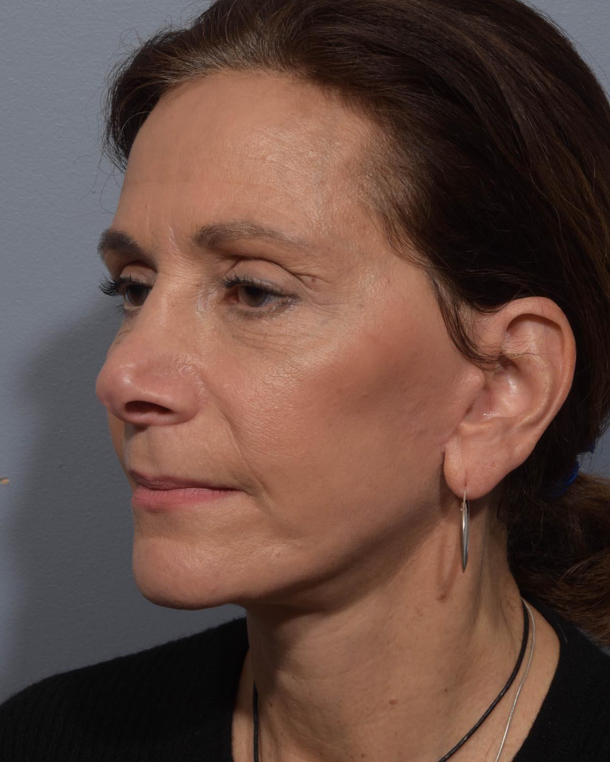 After Lower Blepharoplasty, facelift and neck lift, full face Laser resurfacing with CO2 Oblique