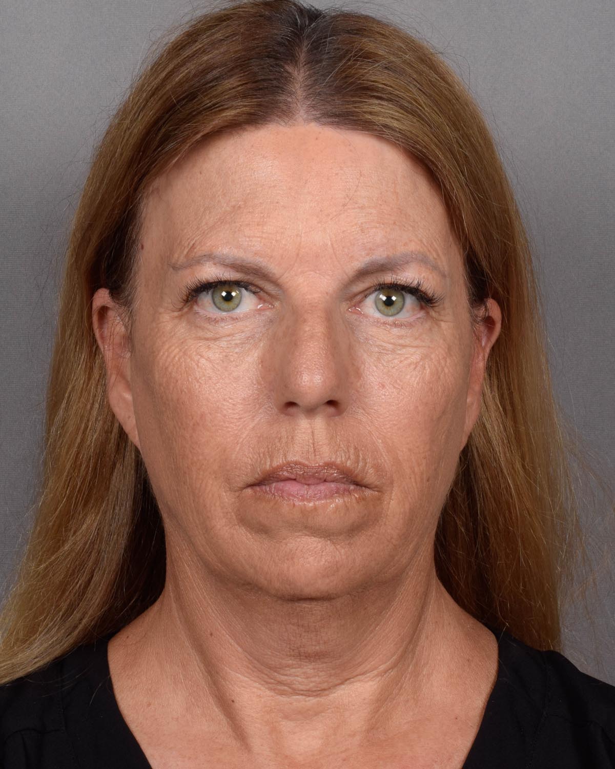 Before Facelift - Vegas Facial Plastics, Mehdi Sina, MD