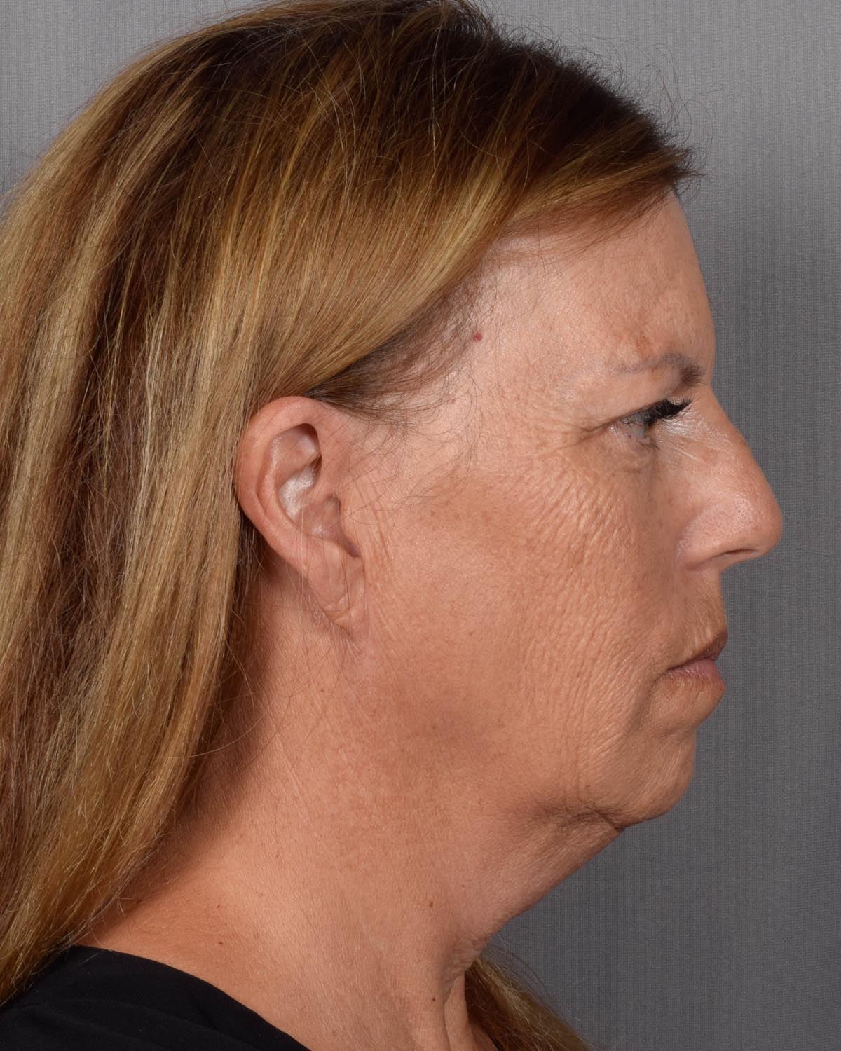 Before Facelift Profile - Vegas Facial Plastics, Mehdi Sina, MD