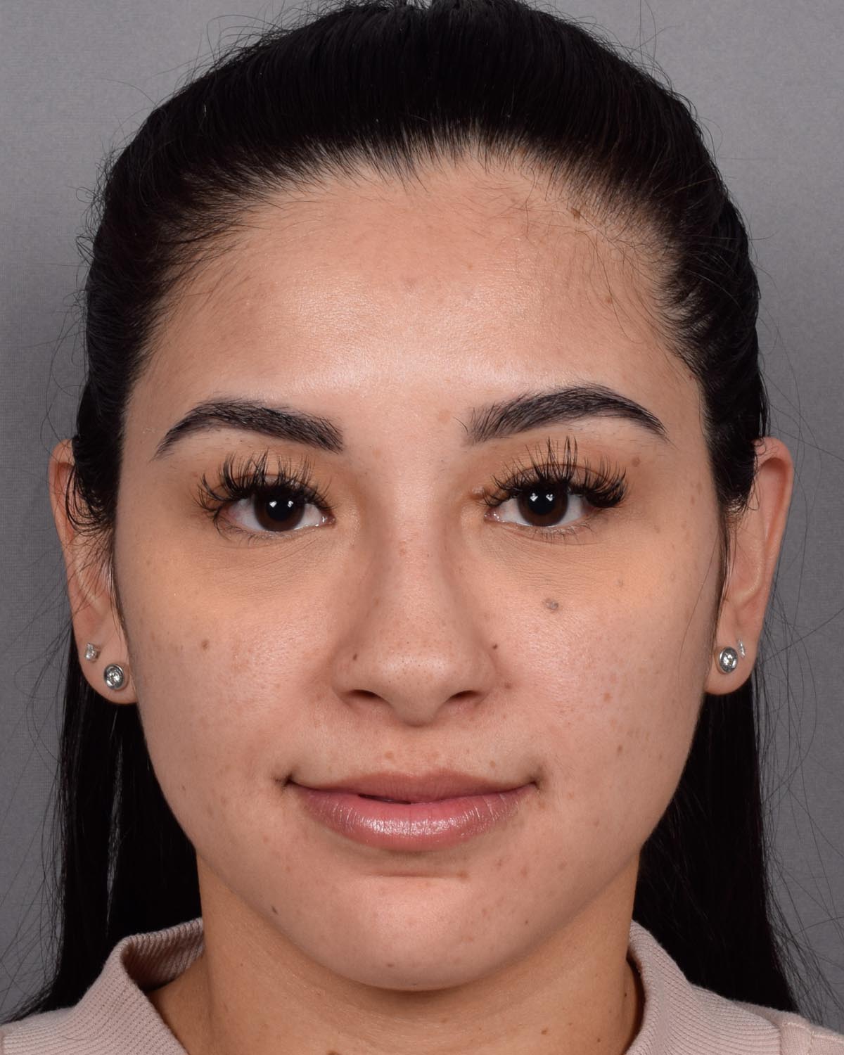 Before Revision and Functional Rhinoplasty - Vegas Facial Plastics, Mehdi Sina, MD