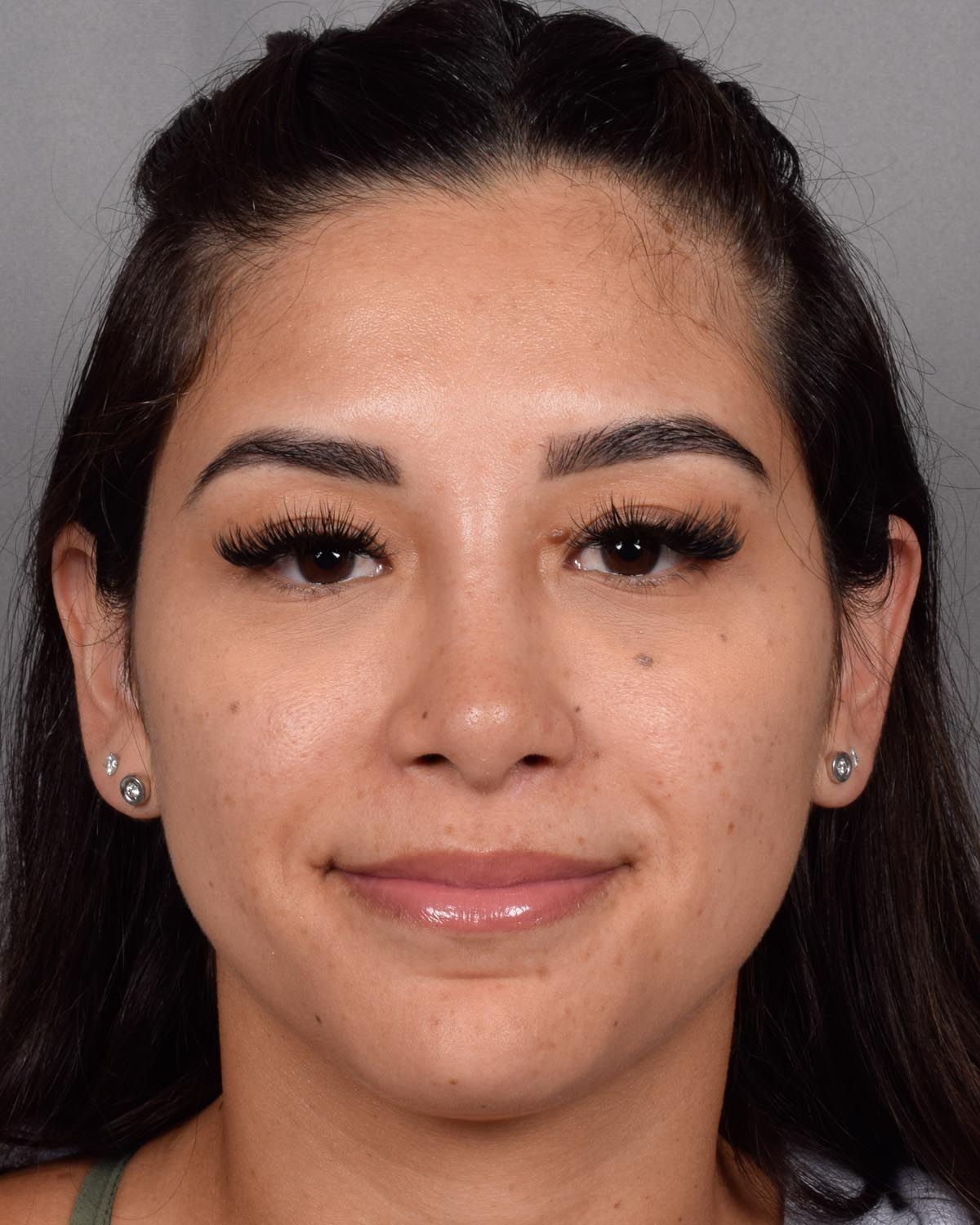 After Revision and Functional Rhinoplasty - Vegas Facial Plastics, Mehdi Sina, MD