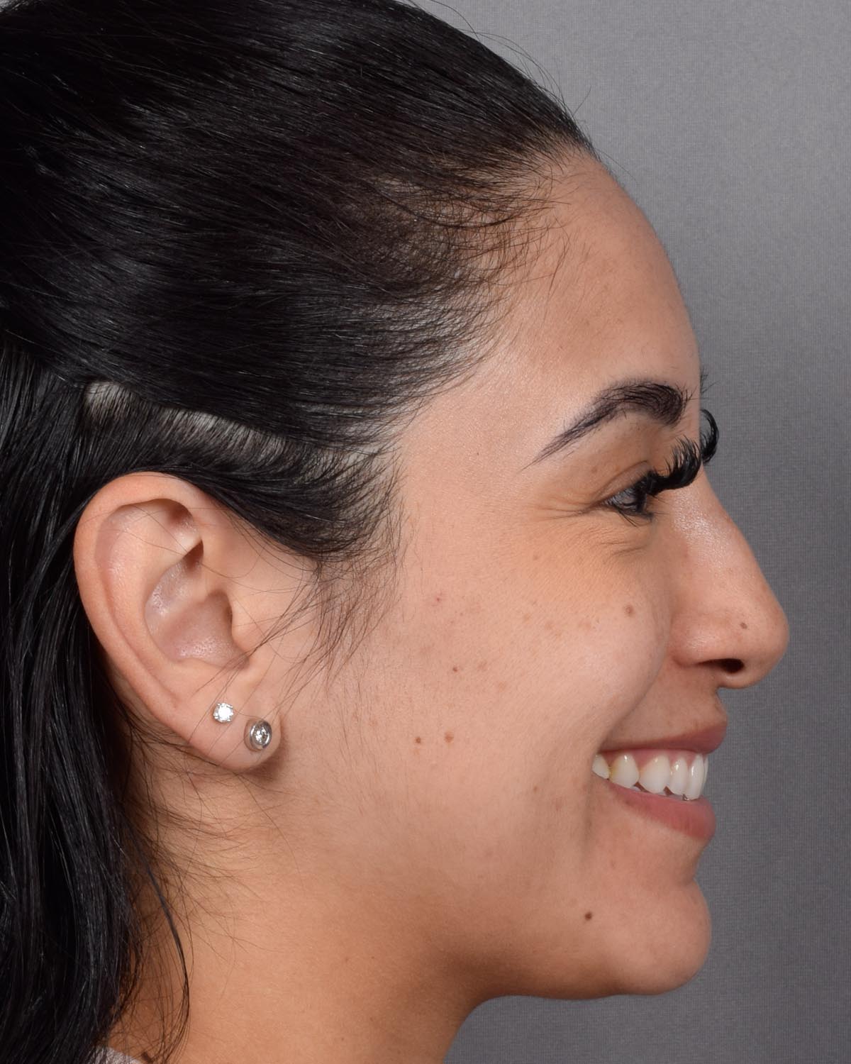 Before Revision and Functional Rhinoplasty Profile Smiling - Vegas Facial Plastics, Mehdi Sina, MD
