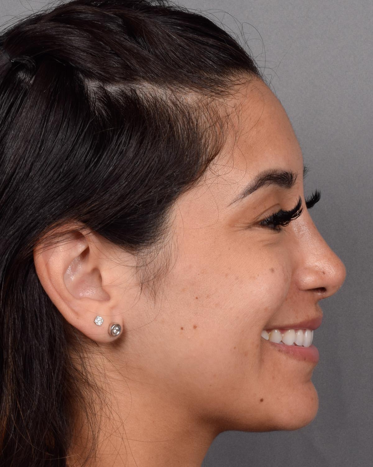 After Revision and Functional Rhinoplasty Profile Smiling - Vegas Facial Plastics, Mehdi Sina, MD