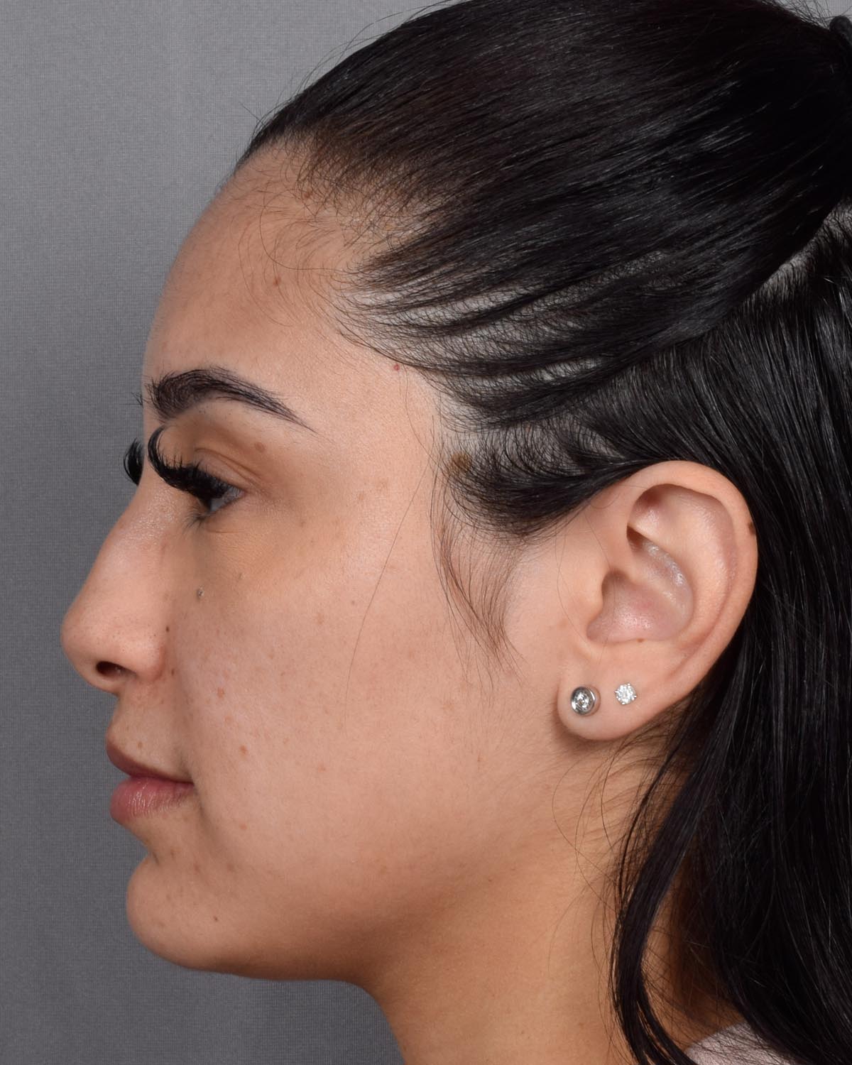 Before Revision and Functional Rhinoplasty Profile - Vegas Facial Plastics, Mehdi Sina, MD