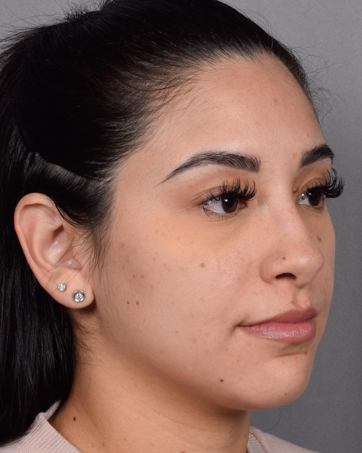 Before Revision and Functional Rhinoplasty Oblique - Vegas Facial Plastics, Mehdi Sina, MD