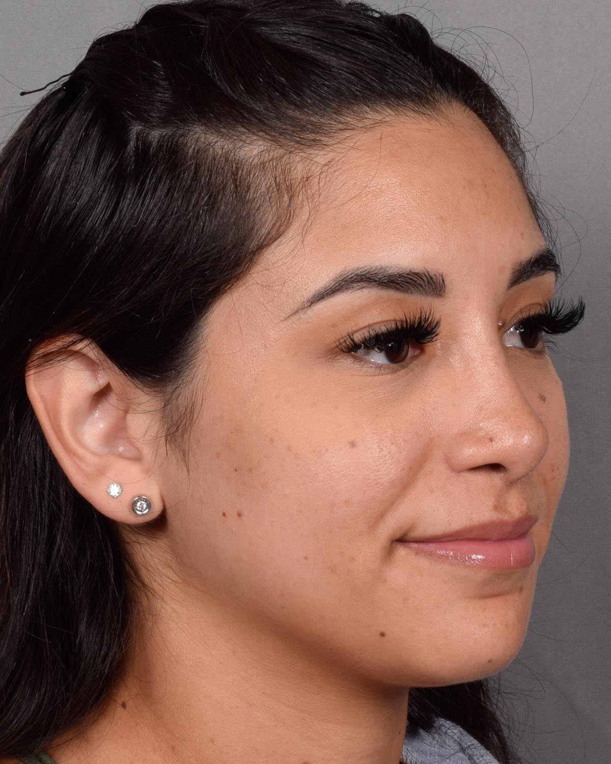 After Revision and Functional Rhinoplasty Oblique - Vegas Facial Plastics, Mehdi Sina, MD