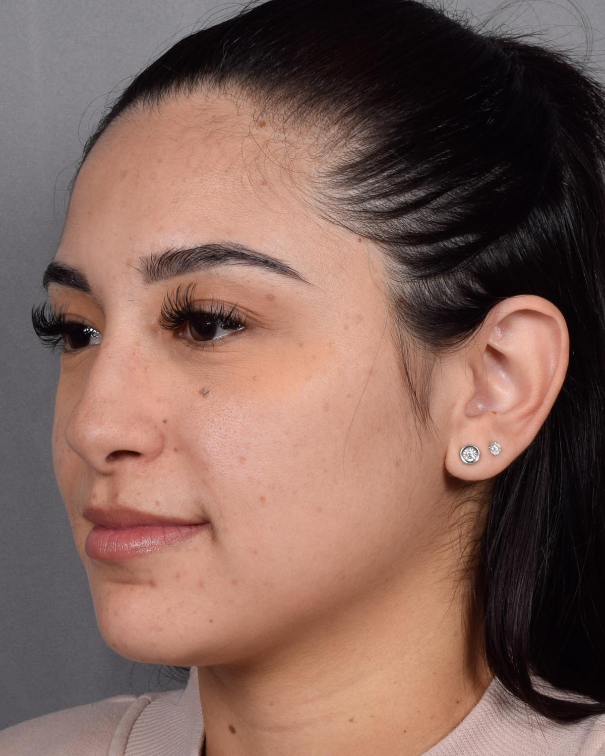 Before Revision and Functional Rhinoplasty Oblique - Vegas Facial Plastics, Mehdi Sina, MD
