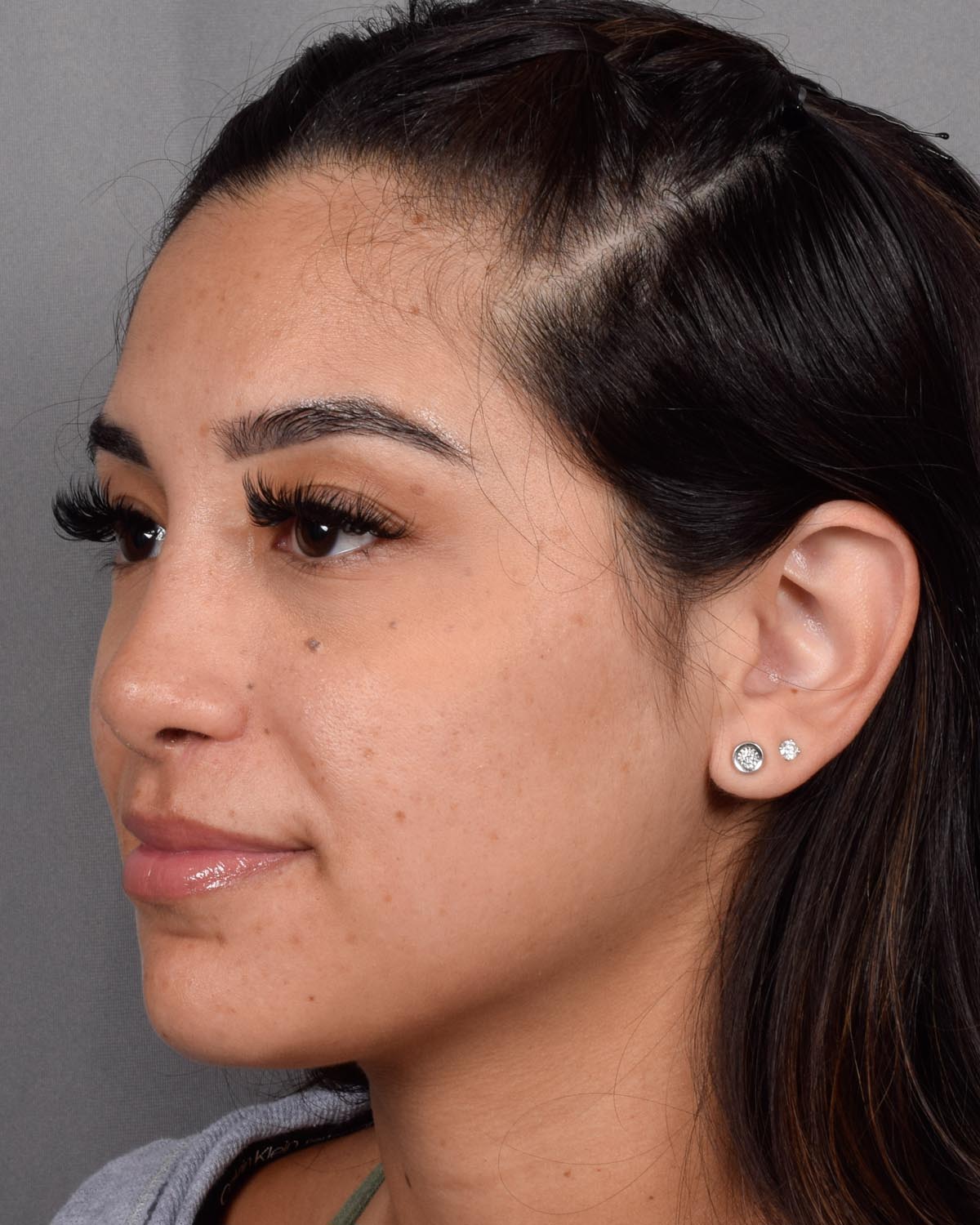 After Revision and Functional Rhinoplasty Oblique - Vegas Facial Plastics, Mehdi Sina, MD